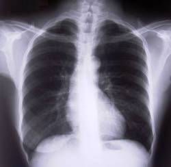 Chest x-ray showing heart position
